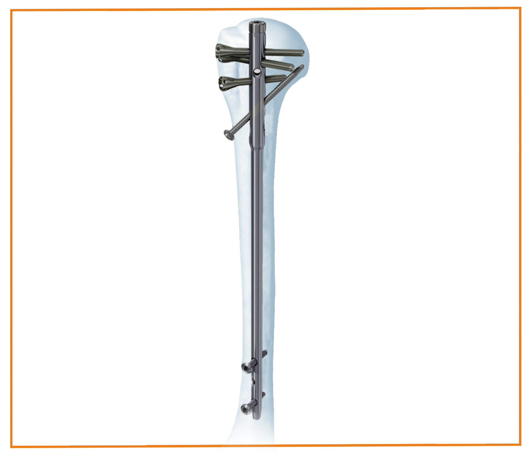 Humeral Nail